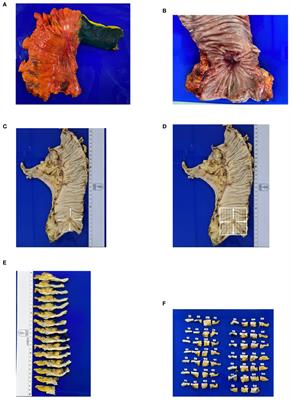 Identification of radiologic and clinicopathologic variables associated with tumor regression pattern and distribution of cancer cells after short-course radiotherapy and consolidation chemotherapy in patients with rectal cancer